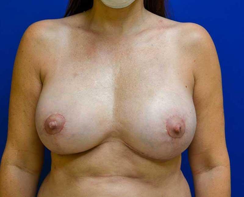 Breast Augmentation Revision Before & After Image