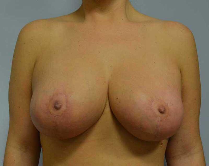 Breast Augmentation Revision Before & After Image